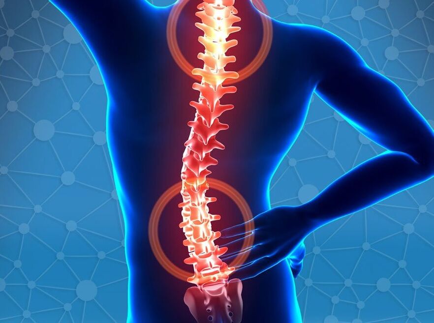 Osteocondrose da columna