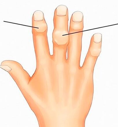 Nódulos de Heberden e Bouchard nas articulacións interfalánxicas con artrose