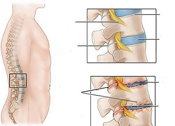 Cambios nos discos intervertebrais debido á osteocondrose
