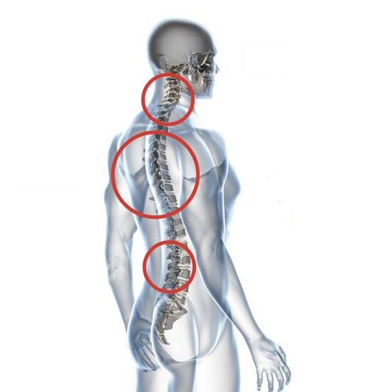 Como se manifesta a osteocondrose
