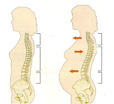 Osteocondrose durante o embarazo