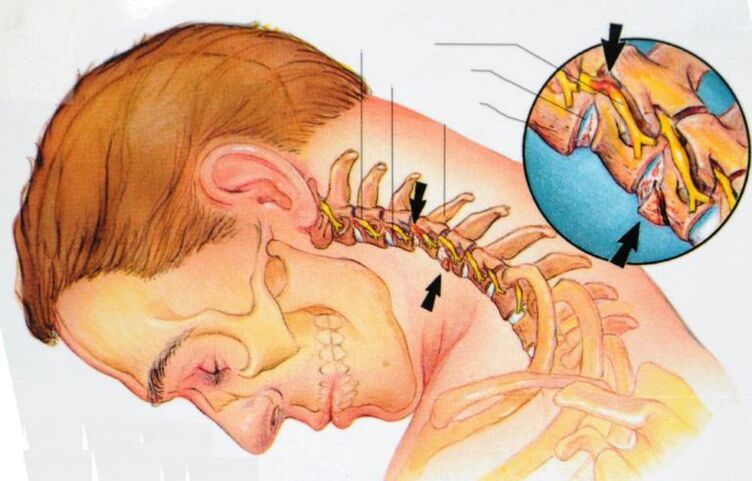 Síntomas da osteocondrose cervical